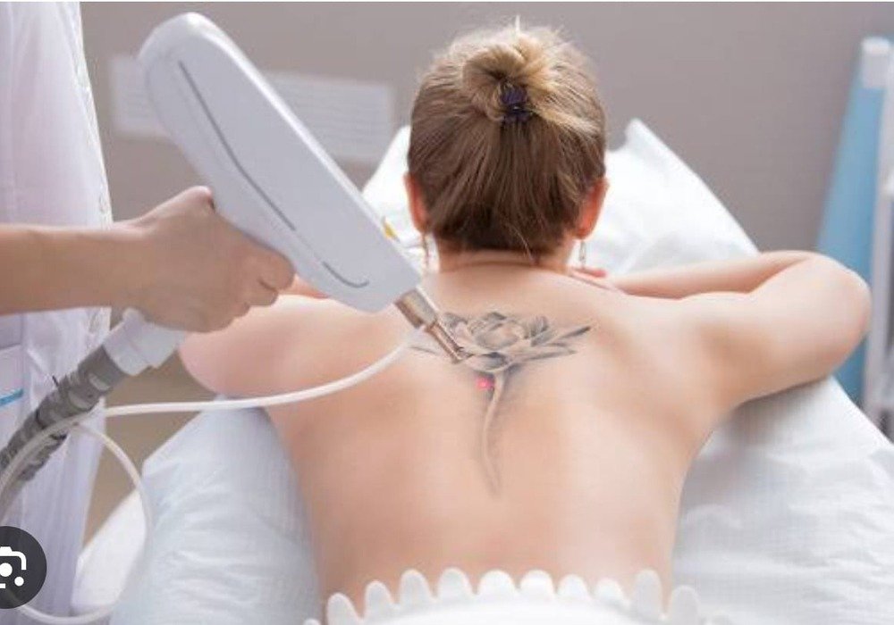 Tattoo Removal Treatment treatment at Adrin's Glo